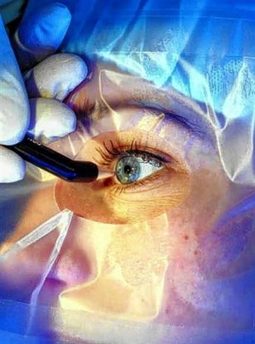 Tratamentos de Cirurgias - cirurgias refrativas - clinica oftalmologica Dr. alfredo brandão