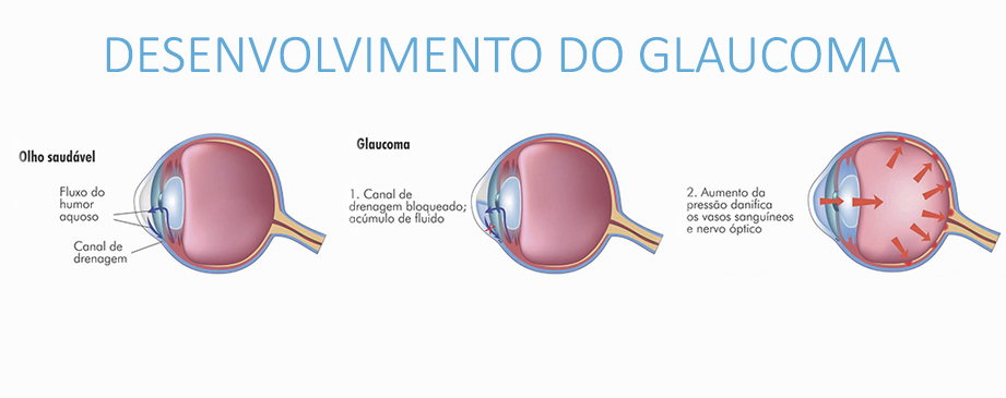 Desenvolvimento do glaucoma
