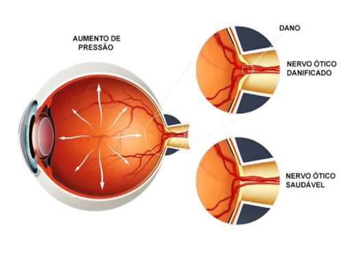 Como o Glaucoma é tratado?