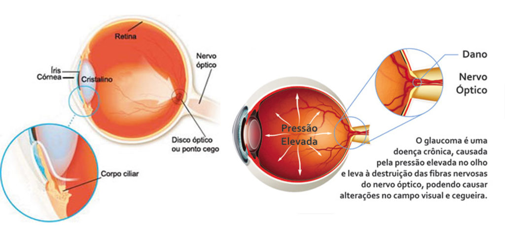 glaucoma clínica gamédica
