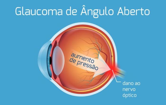 O que é Glaucoma de Angulo aberto